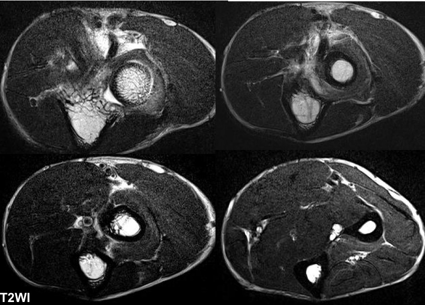 Figure 2 for case Radial tunnel syndrome